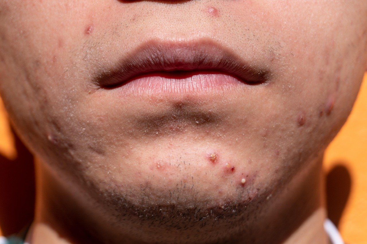 acne, shin, dermatology, skin, puberty, teen, young, treatment, medicine, sickness, remedy, health, cosmetics, acne, acne, acne, acne, acne
